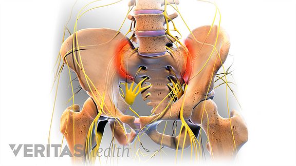 What are some common risks of SI joint fusion surgery?