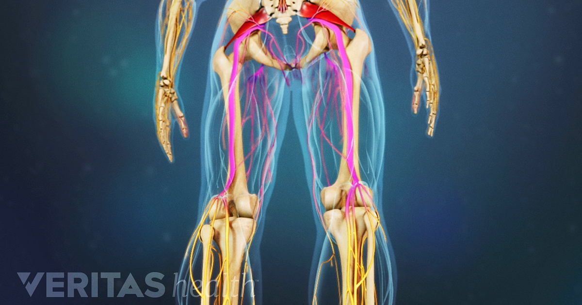 What Is Piriformis Syndrome
