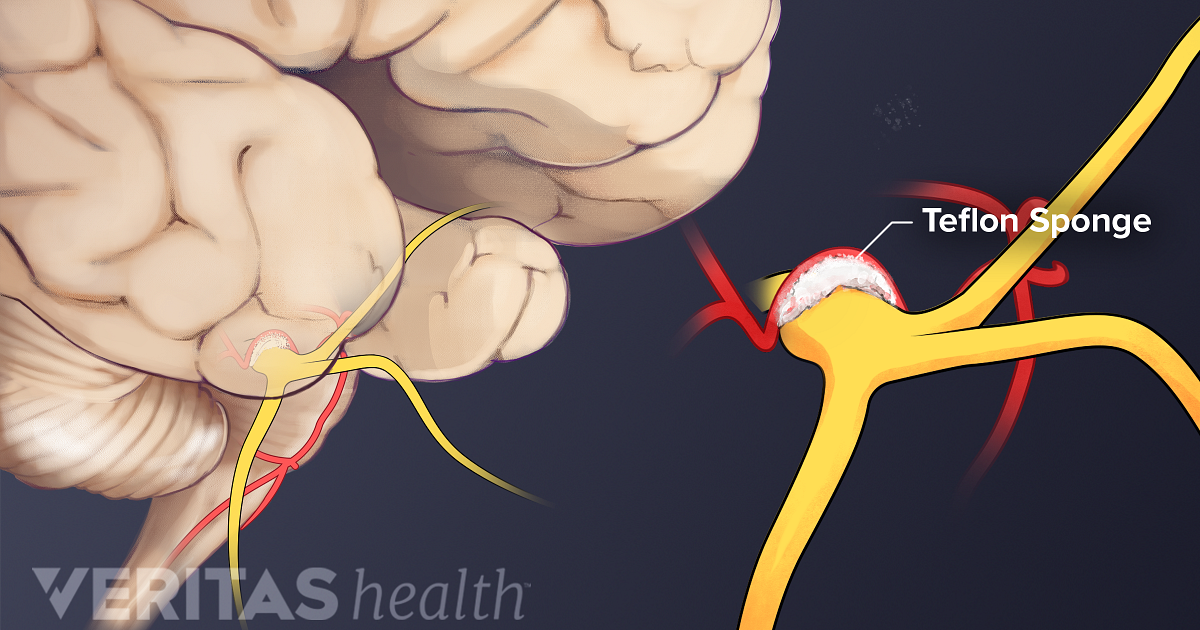 surgery-and-injection-procedures-for-trigeminal-neuralgia