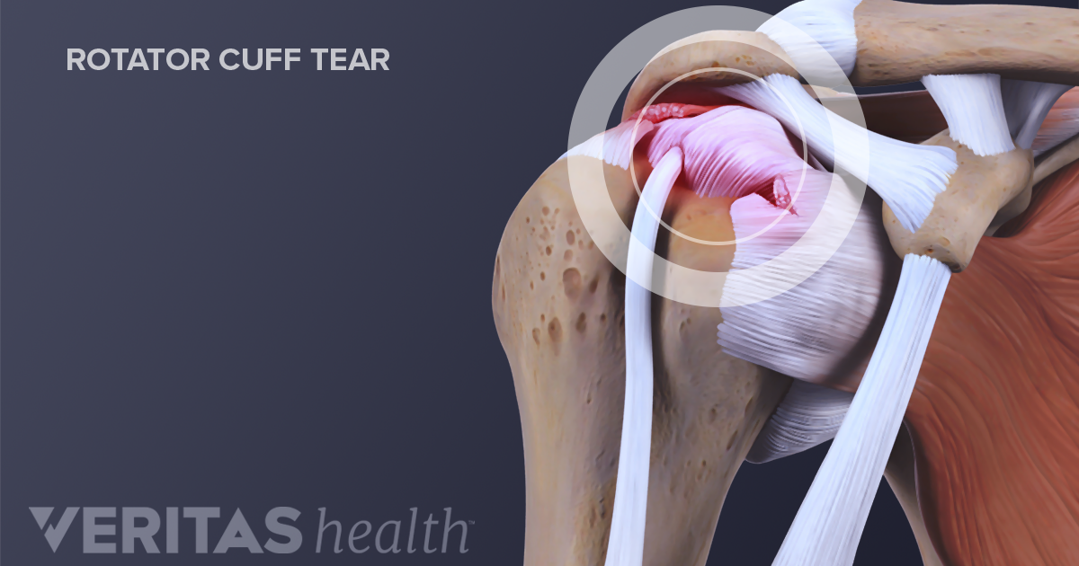 pain relief for torn rotator cuff