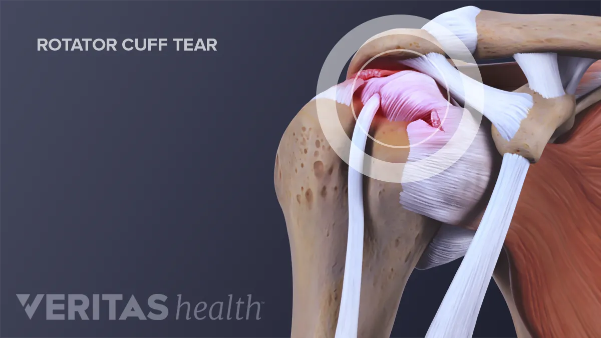 Rotator Cuff Tears From A Car Accident