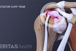 SLAP Tear Shoulder Injury and Treatment