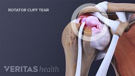 How Do Rotator Cuff Injuries Occur?