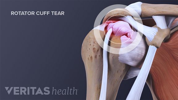 what's a torn rotator cuff