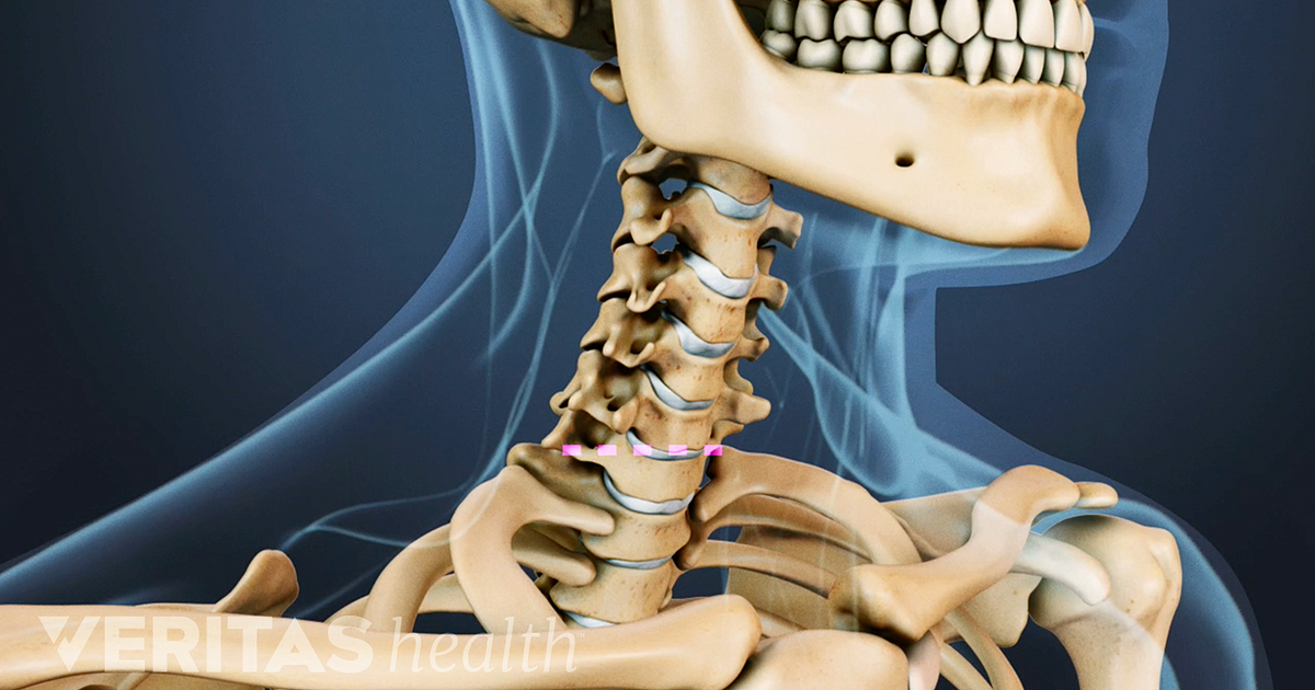 Surgical Procedure For Cervical Disc Replacement