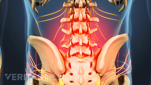 腰椎退行性椎间盘疾病引起的痛苦区域的图像