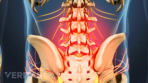 Medical illustration of the lower spine, highlighted in red indicating pain, numbness or tingling