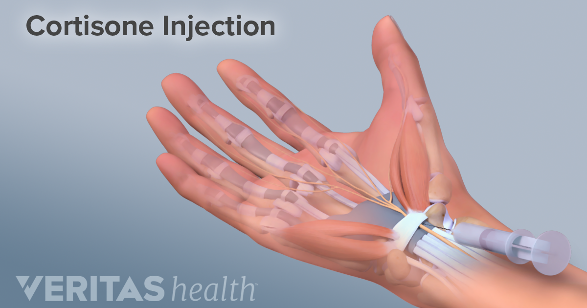 Cortisone Injection Risks And Side Effects   Illustration Wrist Cortisone Injection 