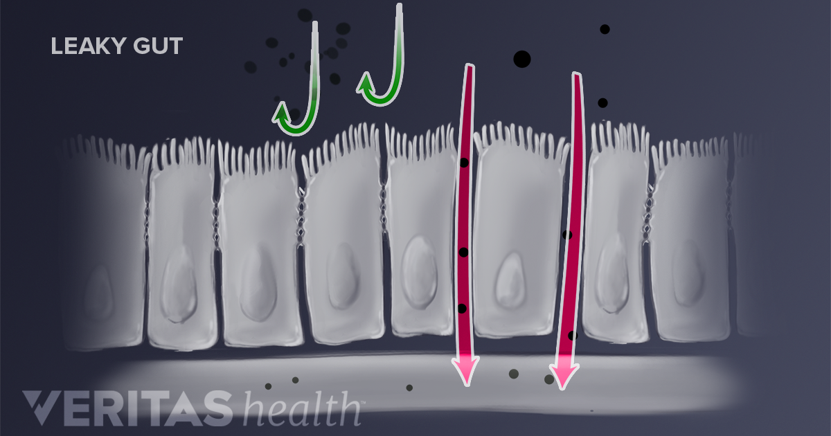 Leaky Gut Definition Defined by Arthritis-Health