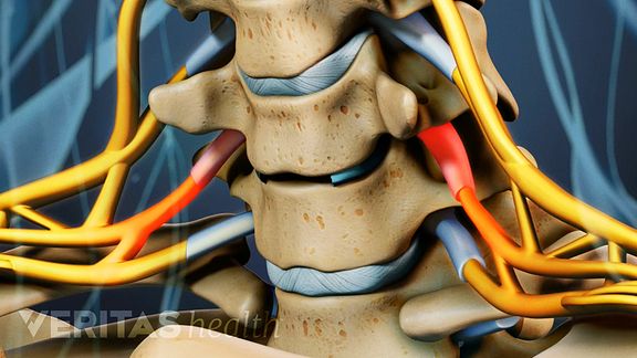 Cervical Disc Replacement Surgery Can Relieve Pain, Numbness, and Weakness