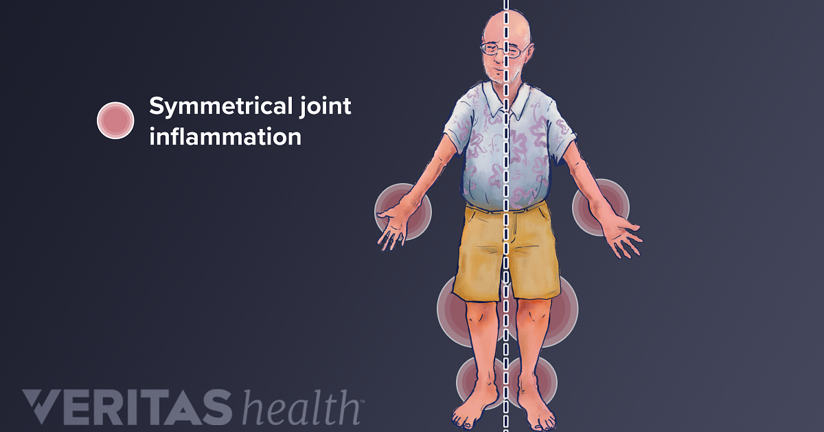 Inflammation Definition | Defined by Arthritis-Health