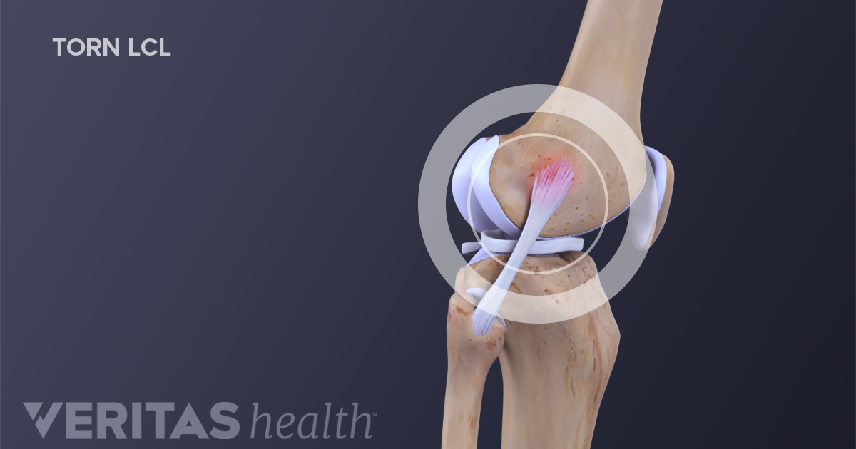 Nonsurgical Treatment for LCL (Lateral Collateral Ligament) Tears