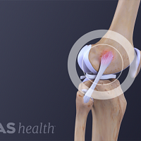 Medical illustration of a torn lateral collateral ligament (LCL)