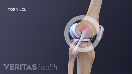 Profile view of the knee joint to show LCL.