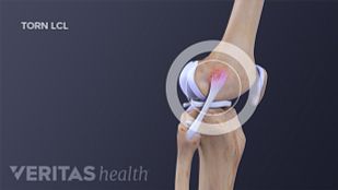 Lateral Collateral Ligament (lcl) Definition 