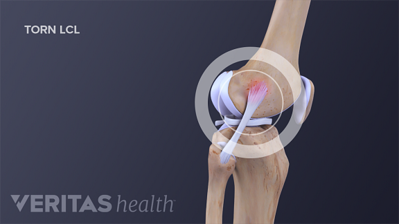 Lateral Collateral Ligament (LCL) Definition | Sports Injury-Related ...