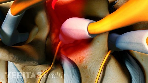 Cervical Facet Joints Bone Spurs