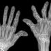 x-ray-image-rheumatoid-arthritis-hands