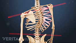 Posterior view of the upper body showing adolescent scoliosis.