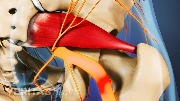 Understanding Piriformis Syndrome