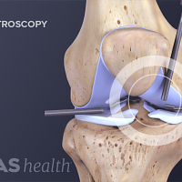 Anterior view of an arthroscopy for knee osteoarthritis.