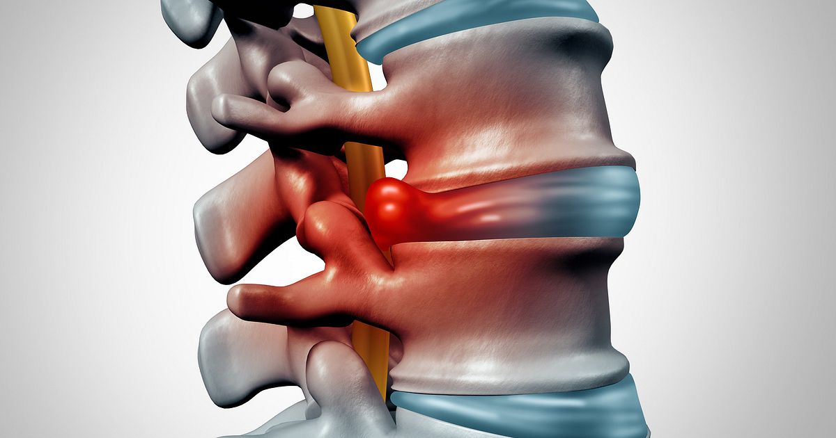 can-herniated-discs-heal-on-their-own