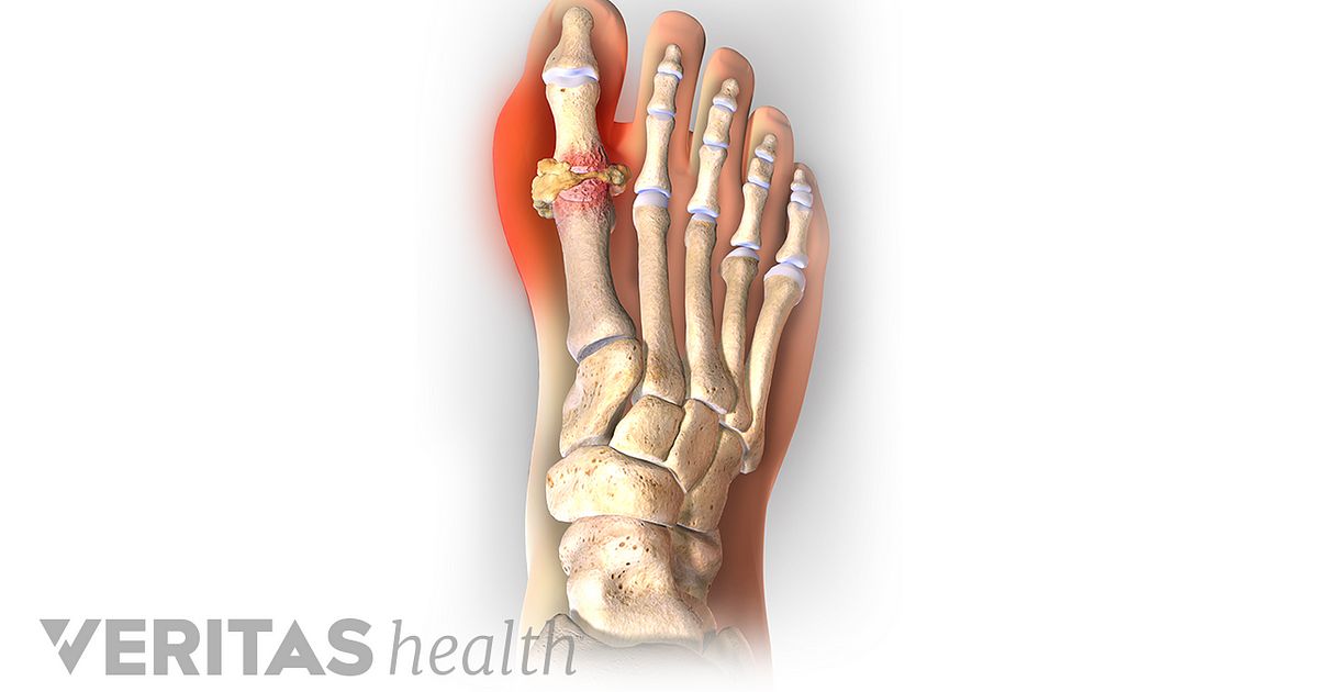 6 Ways to Deal with Painful Gout Attacks