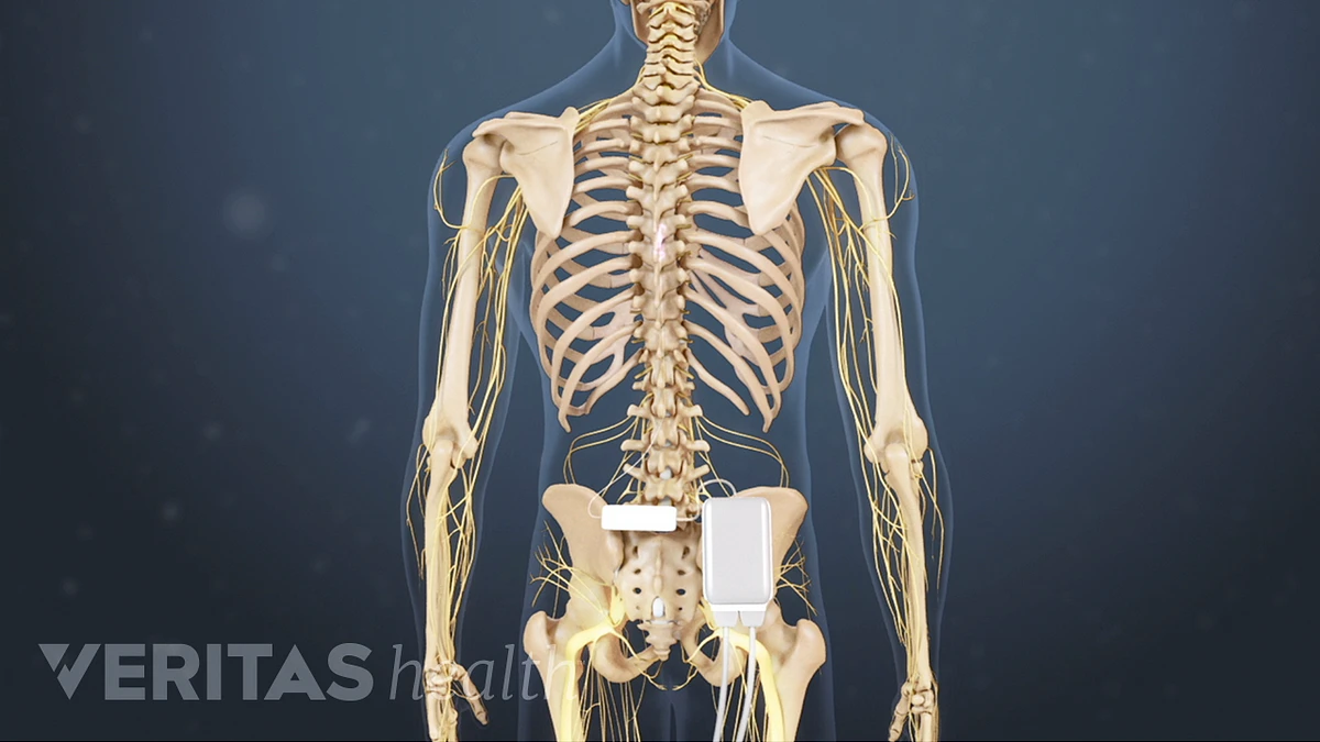 Q&A: Back pain post-surgery? Try a spinal cord stimulator