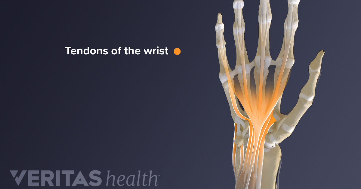 Wrist Tendonitis vs. Sprain