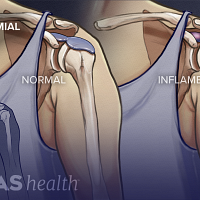 Anterior view of a normal shoulder joint and a joint with a bursa.