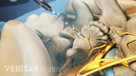 Radiofrequency Neurotomy Electrical Current