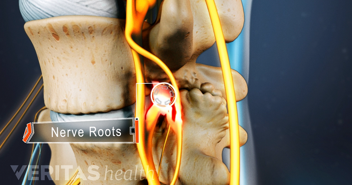 Lumbar Spinal Stenosis Causes and Diagnosis