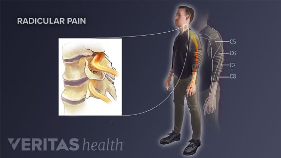 Radiculaire pijn