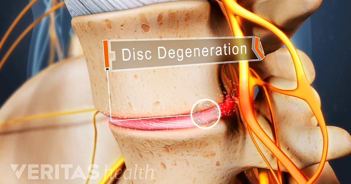 Lumbar Degenerative Disc Disease Treatments