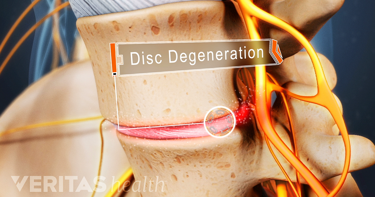 Lumbar Degenerative Disc Disease Overview Causes And Symptoms