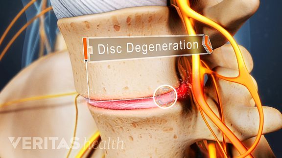 Disc Degeneration