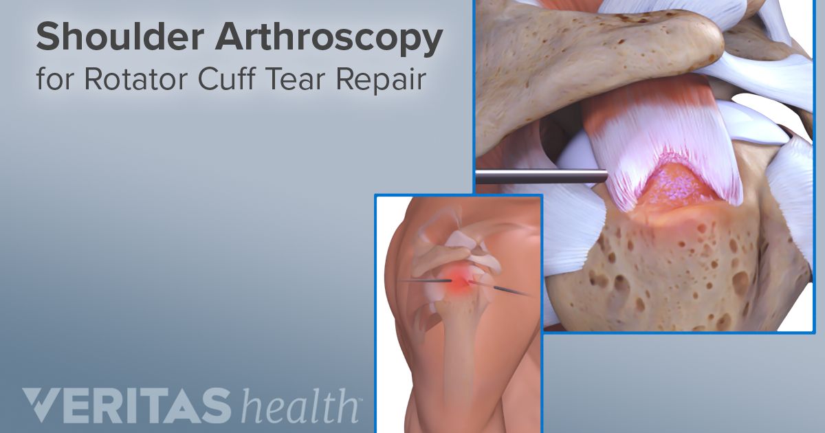 therapy after rotator cuff surgery