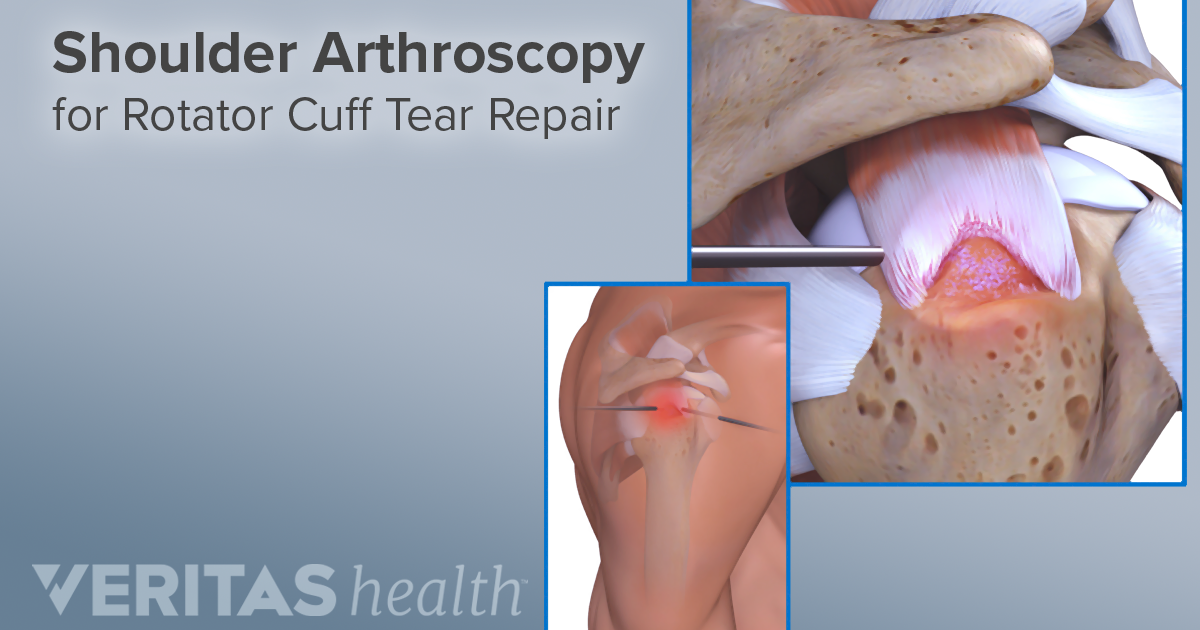 rotator cuff surgery pain