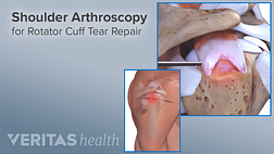 Shoulder arthroscopy for rotator cuff tear repair.