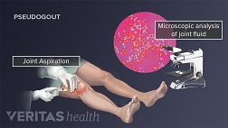 Medical illustration of a knee aspirations and fluid being examined under a microscope