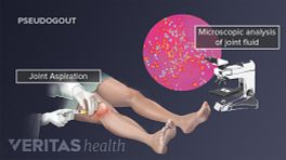 Pseudogout in the knee from the buildup of calcium pyrophosphate crystals.