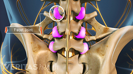 Medical illustration of a spine with the facet joints highlighted