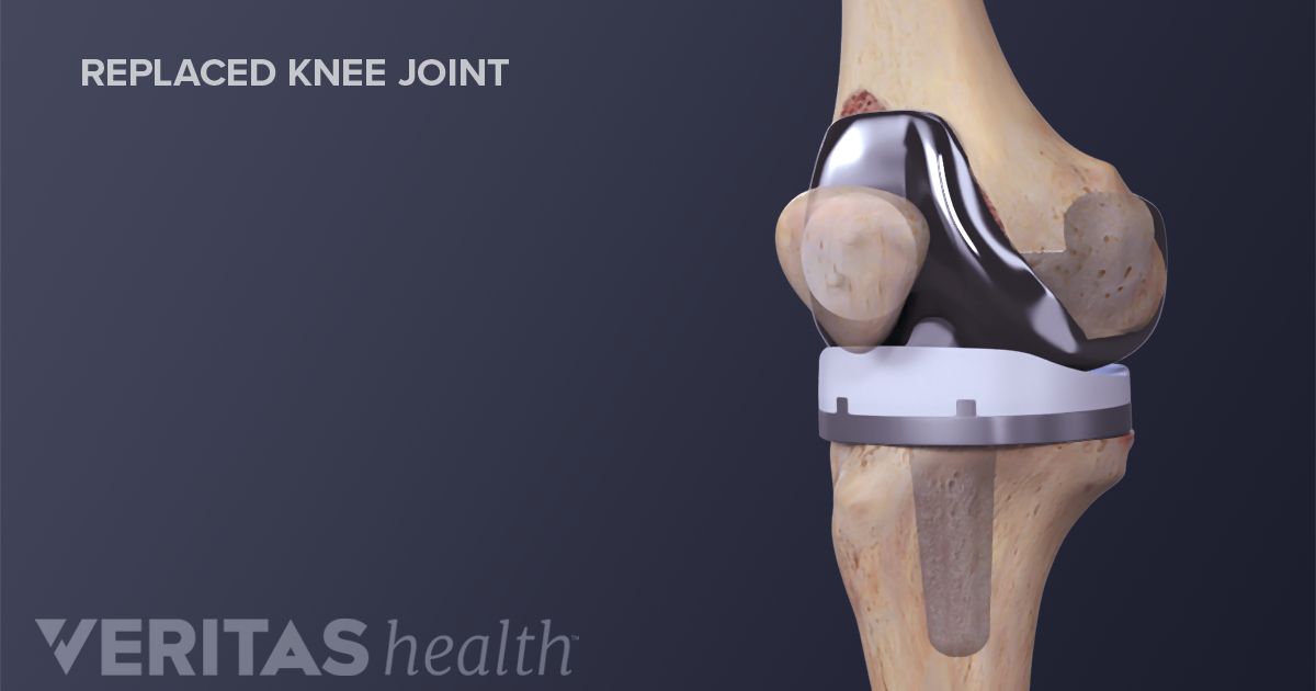 Facts About Outpatient Knee Replacement