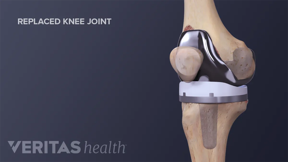 Health Tips(Total Knee Replacement) - Canossa Hospital