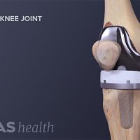 Anterior view of a replaced knee joint.