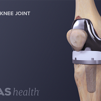 Joint Replacement Surgery Definition | Defined by Arthritis-Health