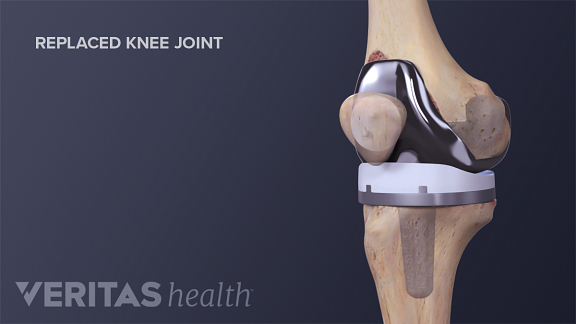 Knee replacement