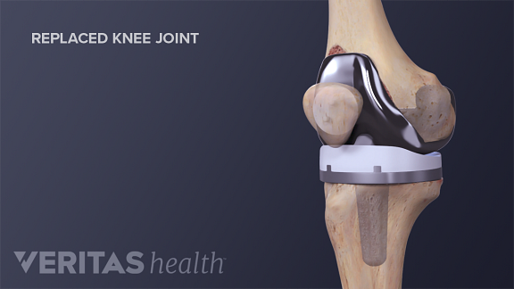 Total Knee Replacement Surgery Recovery