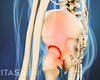 Profile view of SI joint pain in the pelvis.