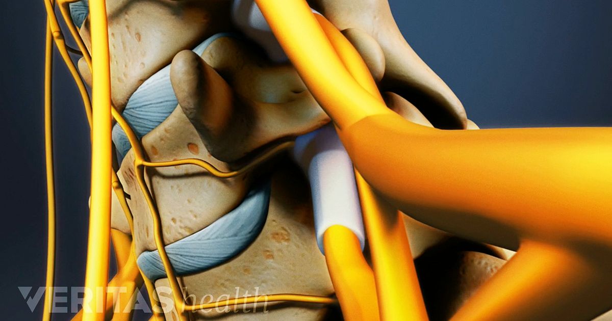 cervical retrolisthesis surgery cervical retrolisthesis surgery